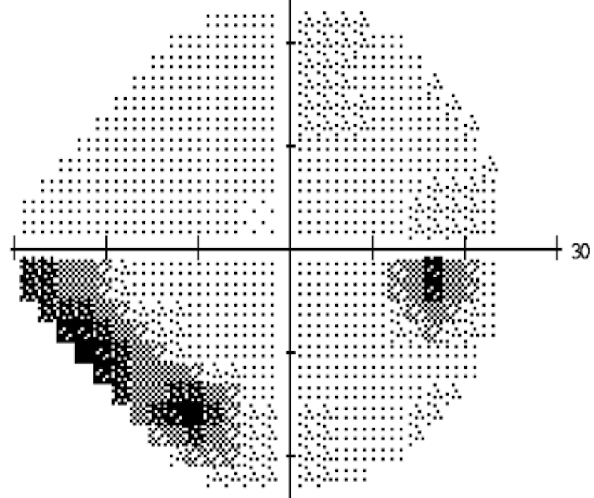 Champ visuel altéré par un glaucome