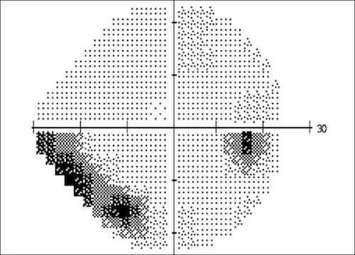 Imprimé type d'un champ visuel