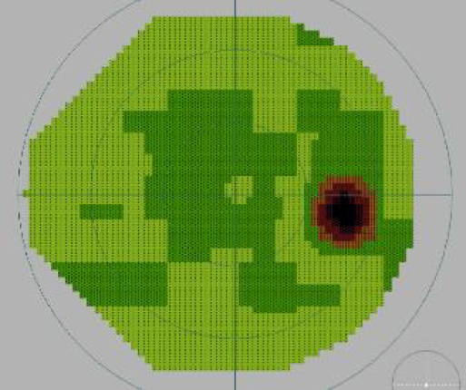 Champ visuel normal avec visualisation de la tache aveugle