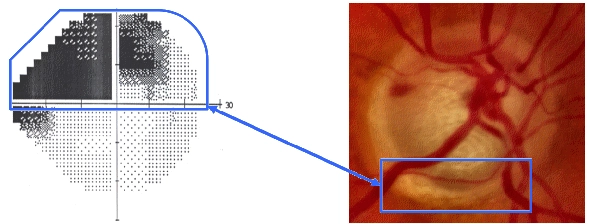 Corrélation entre l'altération d'un champ visuel et l'excavation papillaire 2