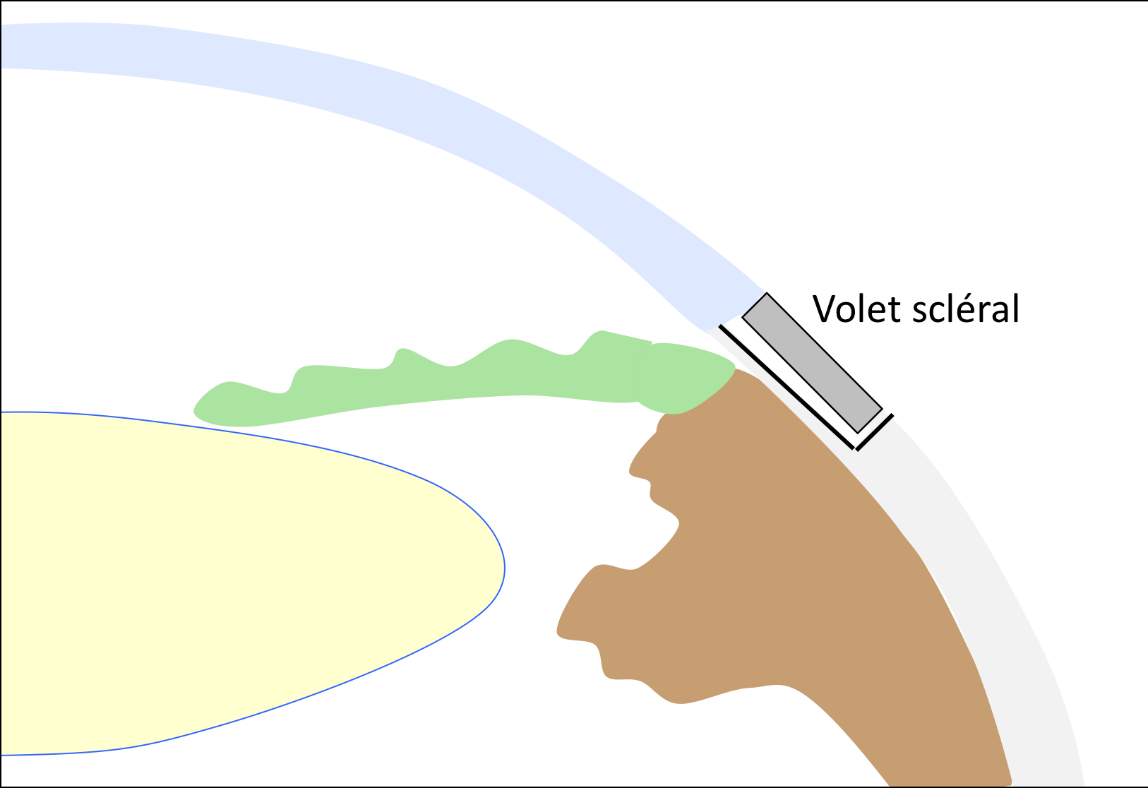 Schéma d'une opération du glaucome : étape 2