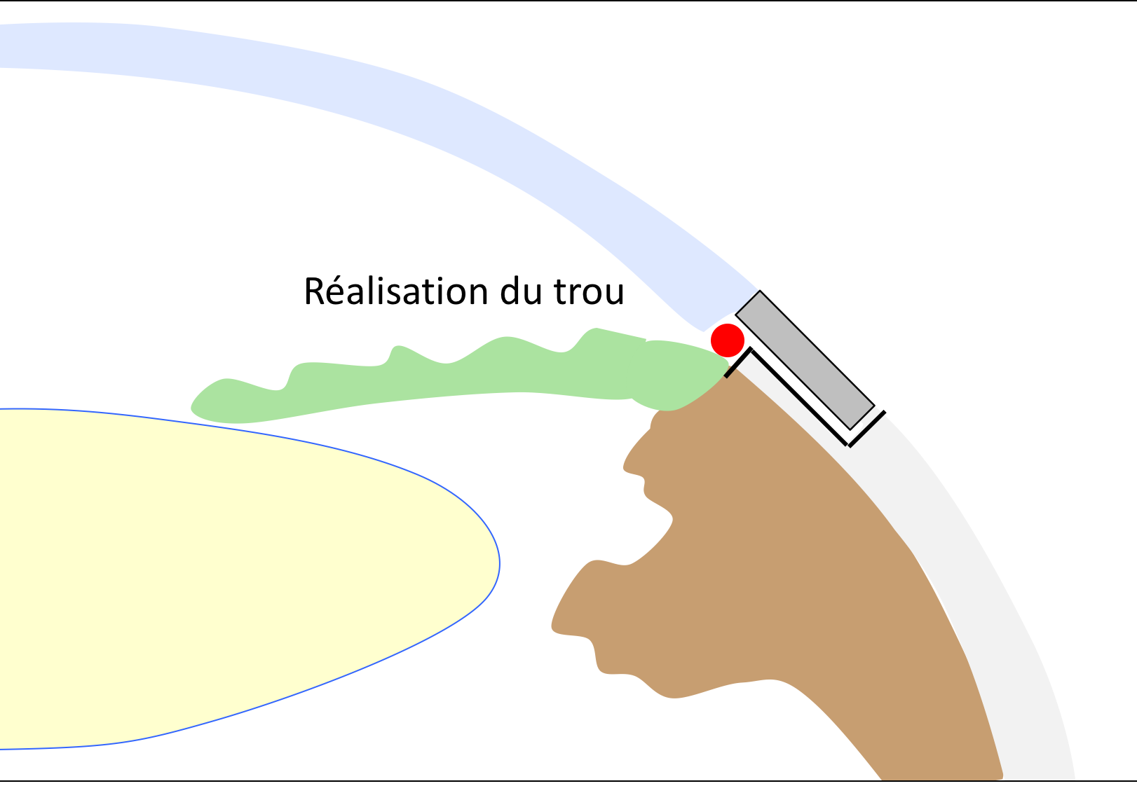 Schéma d'une opération du glaucome : étape 3