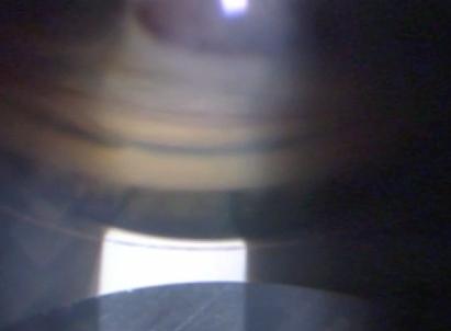 Image d'un angle iridocorneen vu en gonioscopie