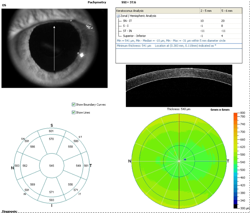 Photo de pachymétrie cornéenne par OCT agrandie