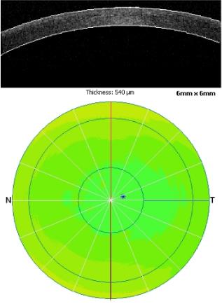 Photo de pachymétrie cornéenne par OCT
