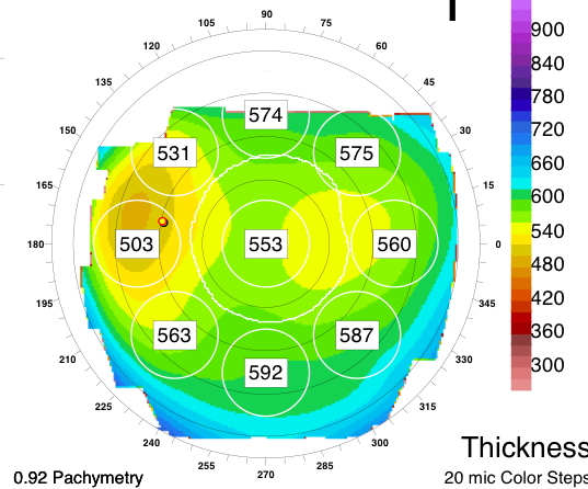 Photo de pachymétrie cornéenne par Orbscan