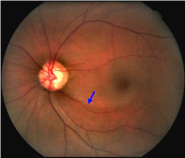 Photo d'un déficit de fibres optiques lié au glaucome