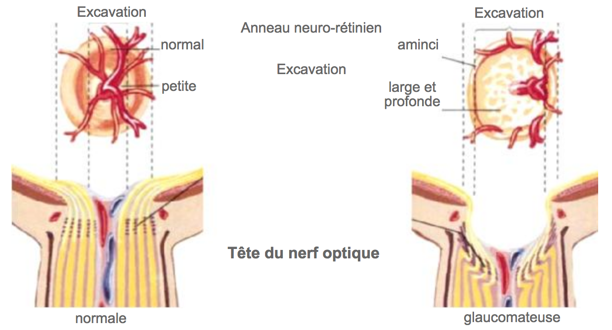 Dessins comparant une papille normale et une papille glaucomateuse