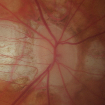 Tête du nerf optique atteinte de glaucome chez un myope 
