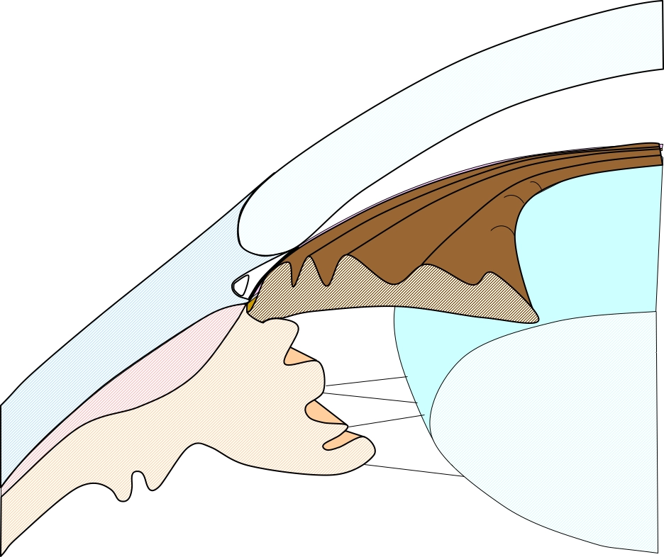 Schéma d'iris épais ostruant l'angle irido-cornéen