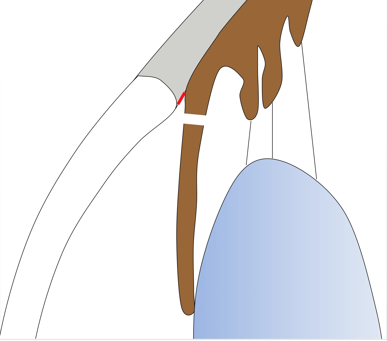 Angle fermé après iridotomie