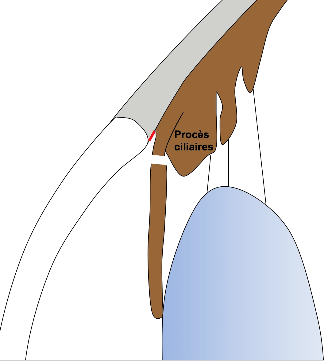 Schéma de syndrome Iris plateau après iridoplastie