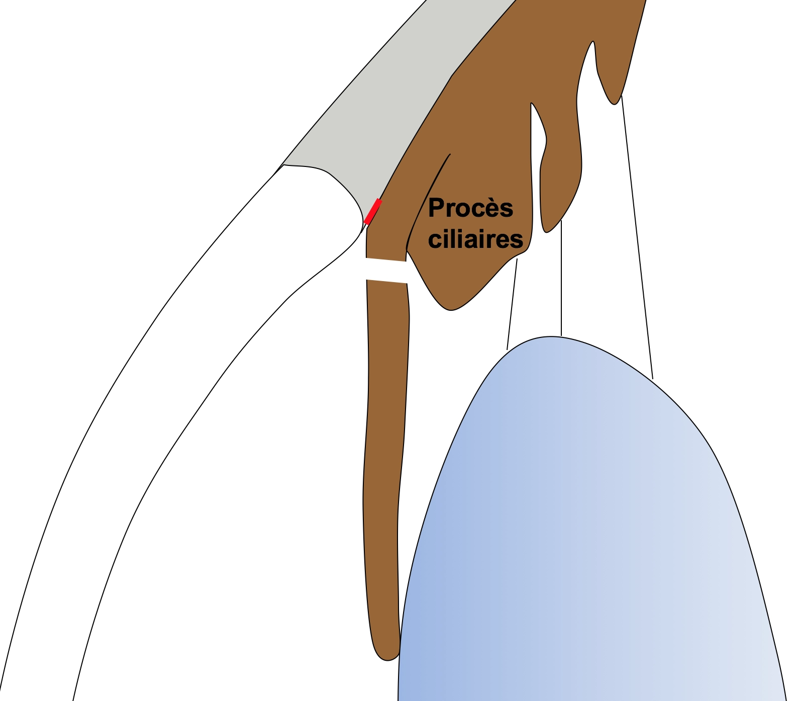 Schéma de syndrome Iris plateau après iridotomie