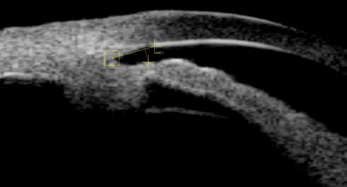 Image UBM d'une insertion antérieure de l'iris sur les procès ciliaires