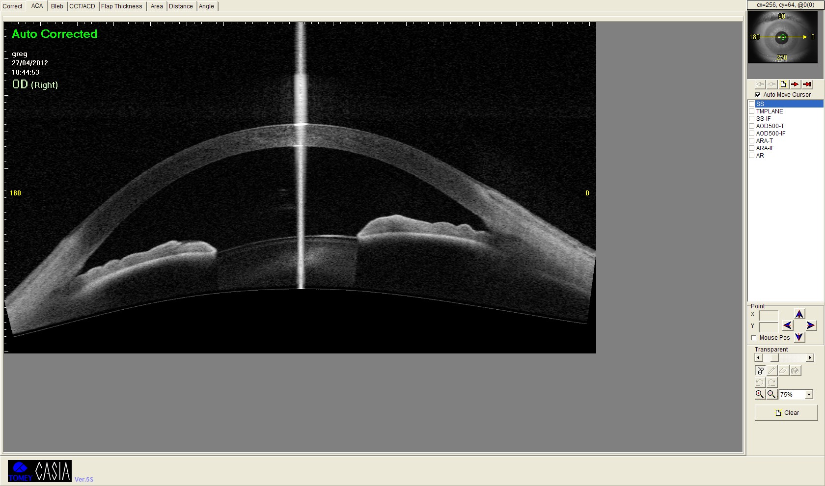 Photo OCT : ouverture de l'angle après phakoexérèse 