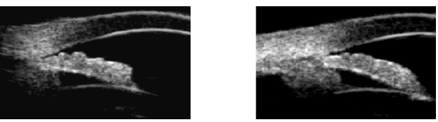 Image UBM d'un angle avant et après iridoplastie dans un cas de syndrome iris plateau
